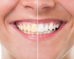 Teeth Whitening Processes – How Does it Work?