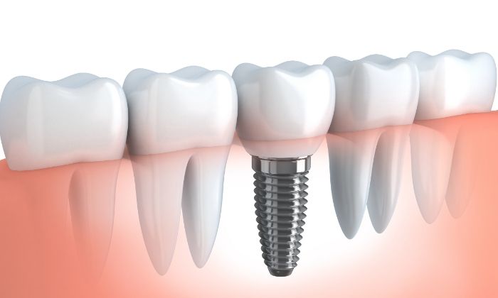 FAQs: Implant-Supported Dentures in Brisbane