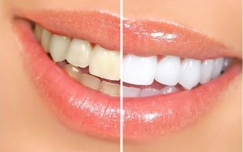 Teeth Whitening Techniques