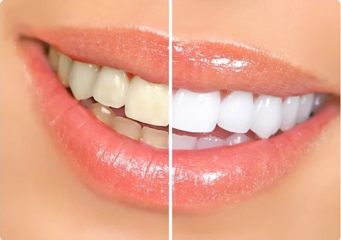 Teeth Whitening Techniques: Insights From A Cosmetic Dentist